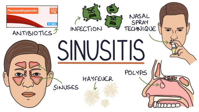 6 Penyebab dari Munculnya Penyakit Sinusitis